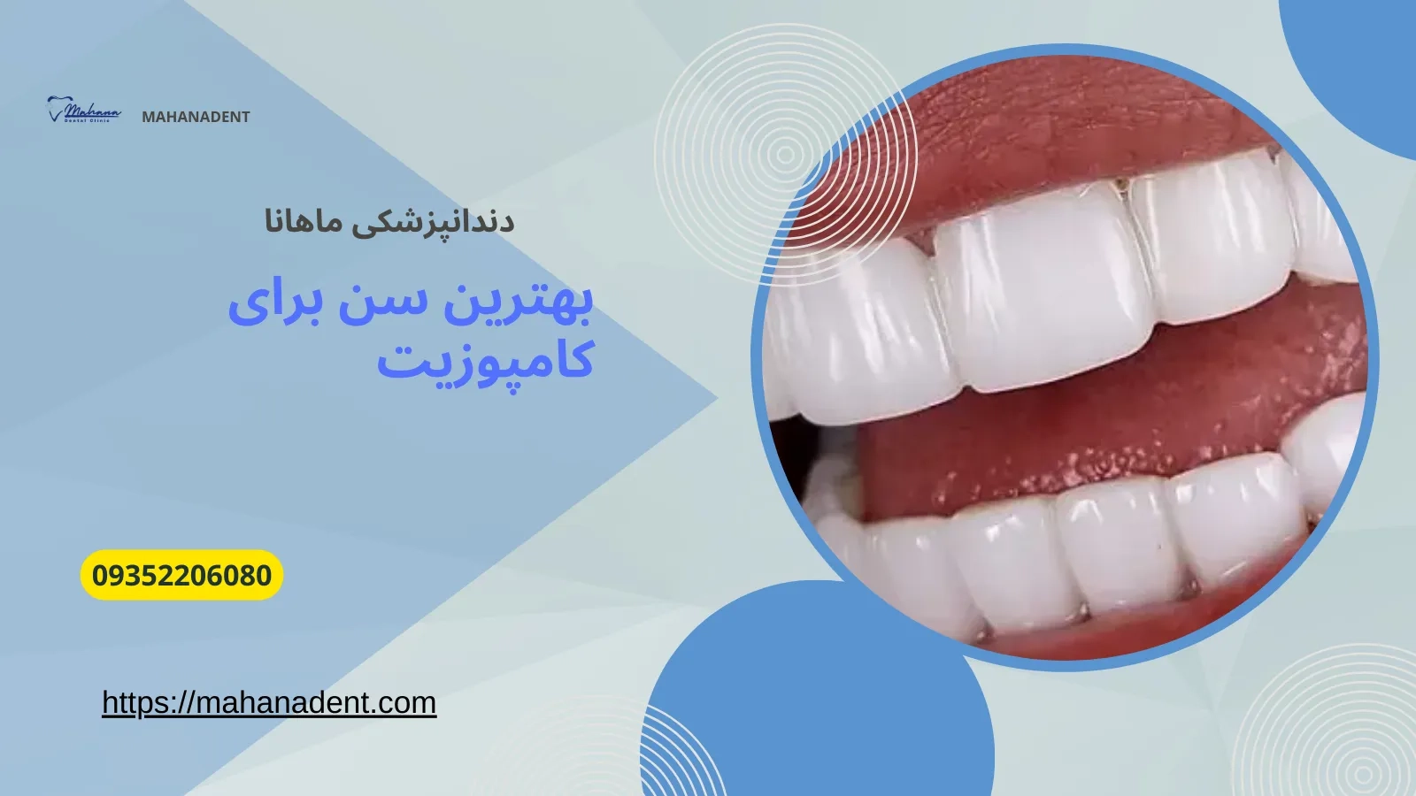 بهترین سن برای انجام کامپوزیت دندان