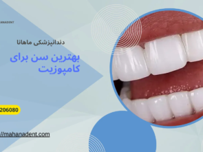 بهترین سن برای انجام کامپوزیت دندان