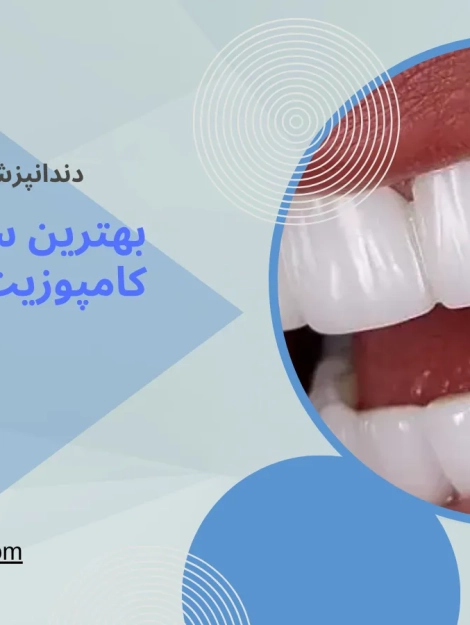 بهترین سن برای انجام کامپوزیت دندان