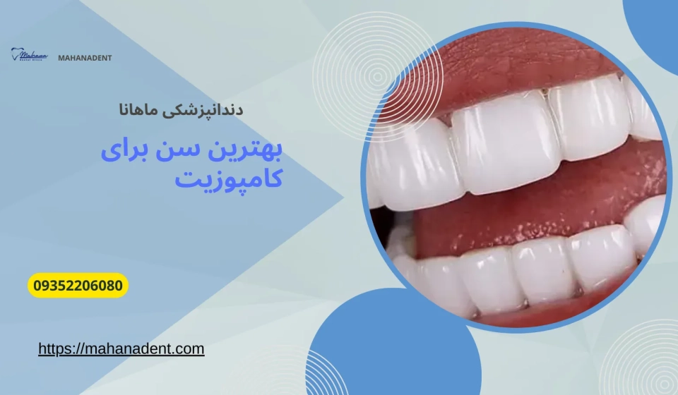 بهترین سن برای انجام کامپوزیت دندان