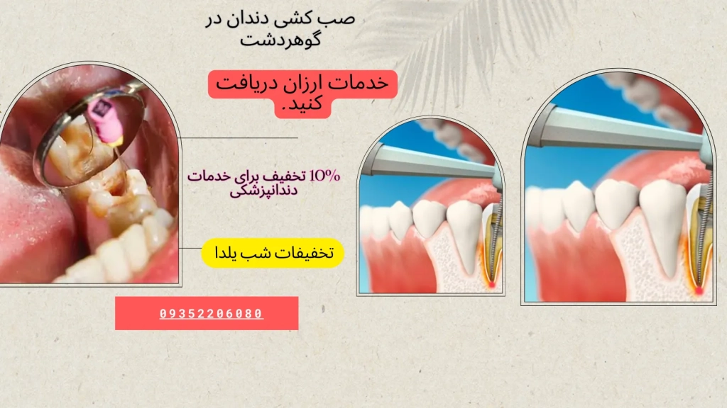 عصب کشی دندان در گوهردشت