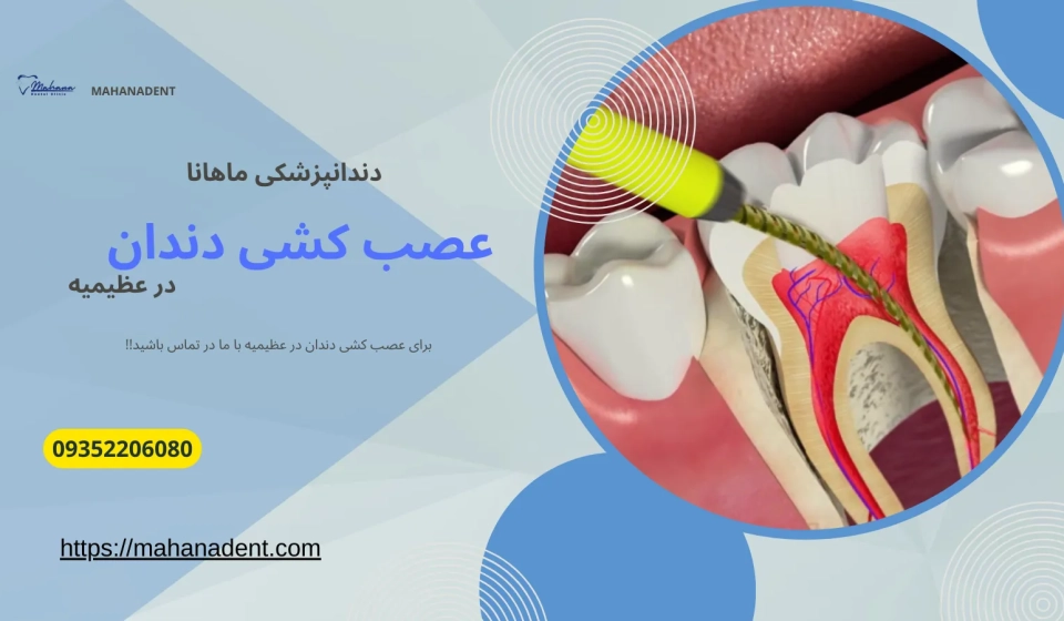 عصب کشی دندان در عظیمیه کرج