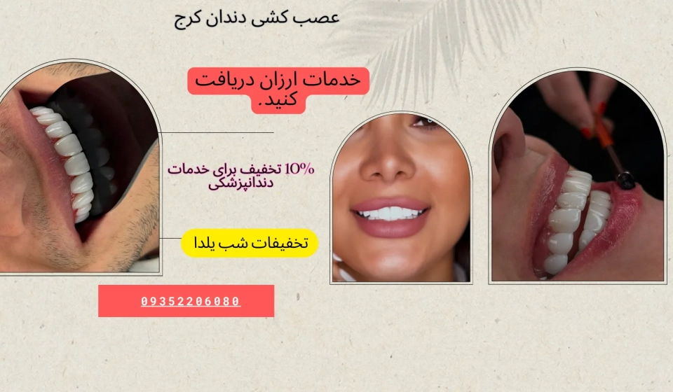 عصب کشی دندان در کرج