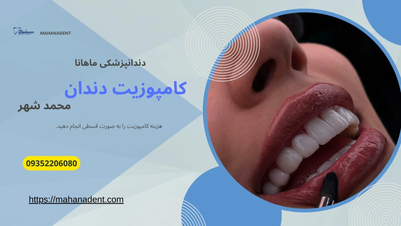 کامپوزیت دندان در محمد شهر