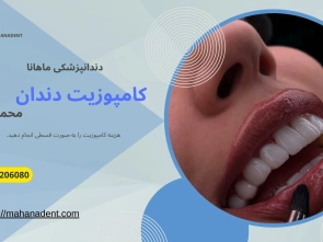 کامپوزیت دندان در محمد شهر