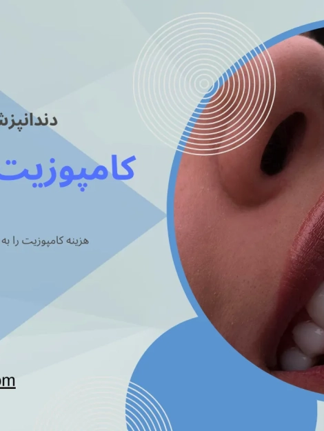 کامپوزیت دندان در محمد شهر