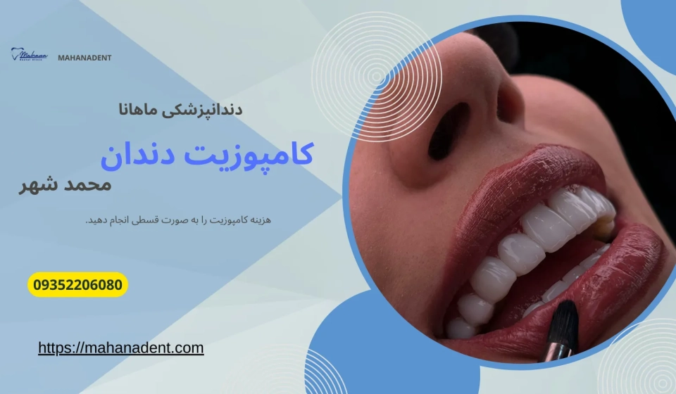 کامپوزیت دندان در محمد شهر