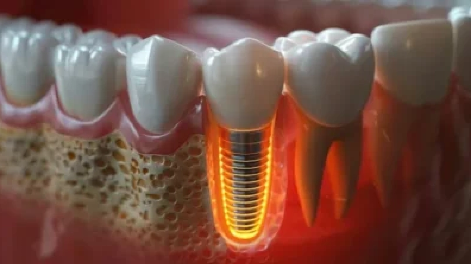 Dental implants