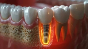 Dental implants