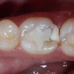 Dental restoration price