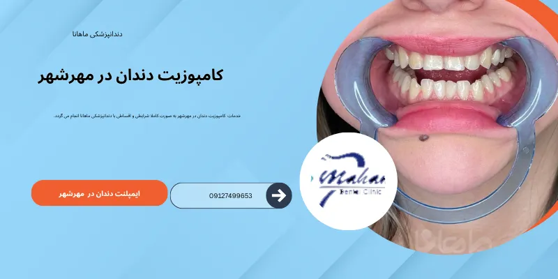 کامپوزیت دندان در مهرشهر