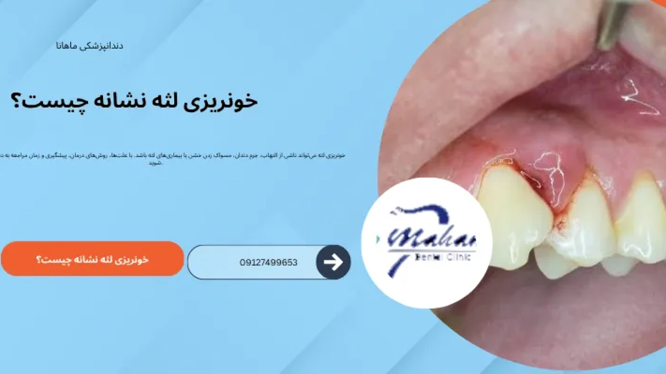 دلیل خون ریزی لثه