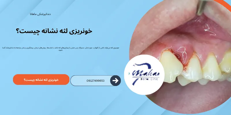 دلیل خون ریزی لثه