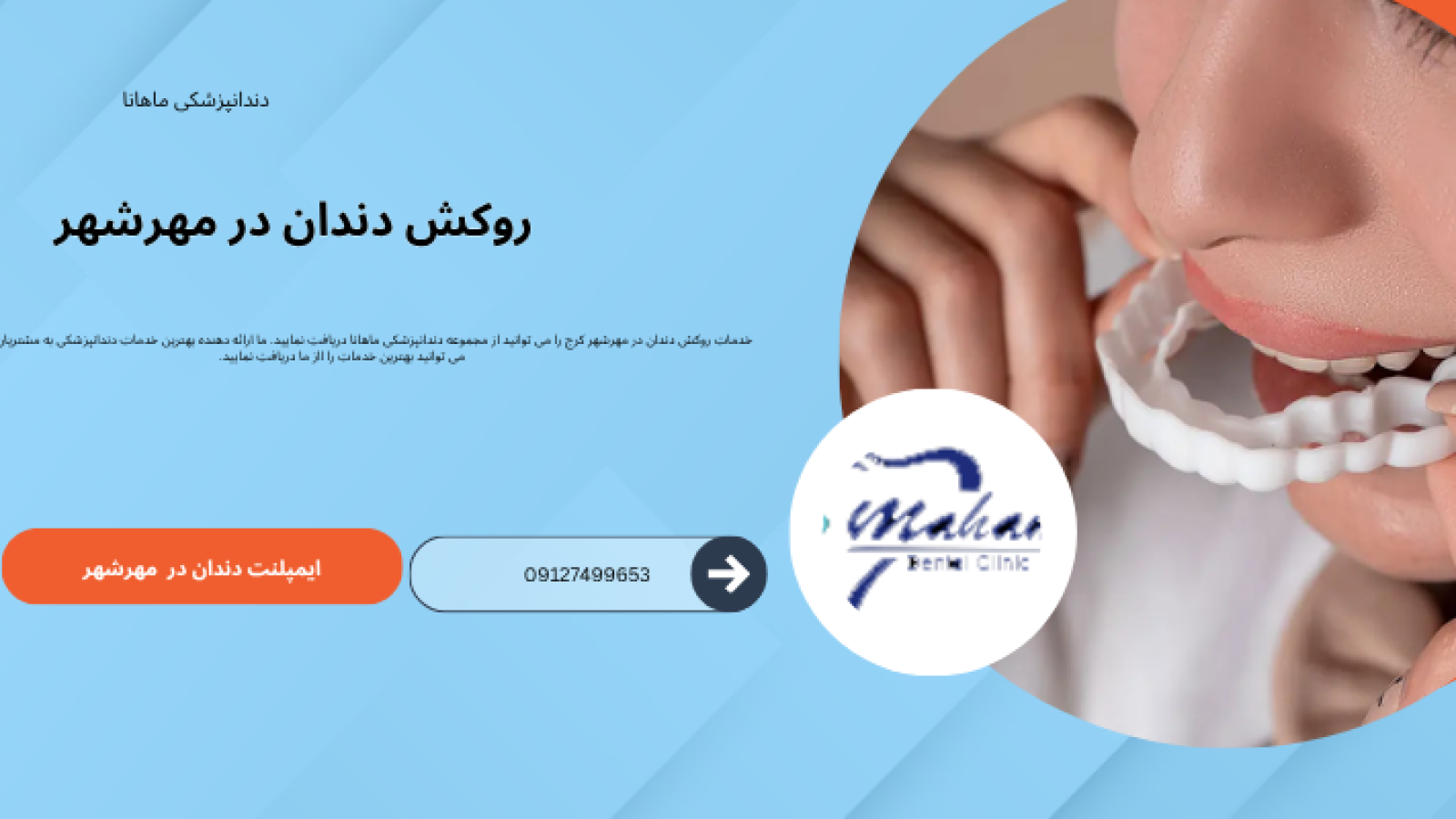 روکش دندان در مهرشهر کرج