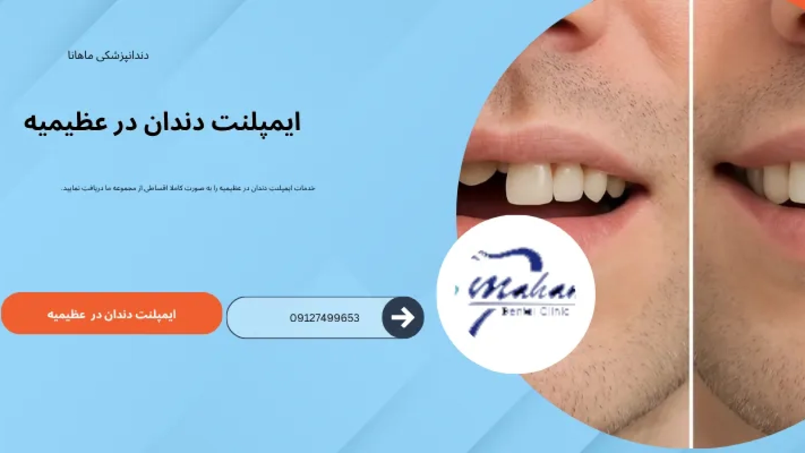 ایمپلنت دندان در عظیمیه کرج