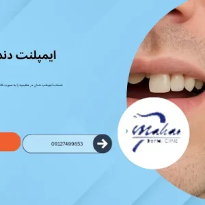 ایمپلنت دندان در عظیمیه کرج