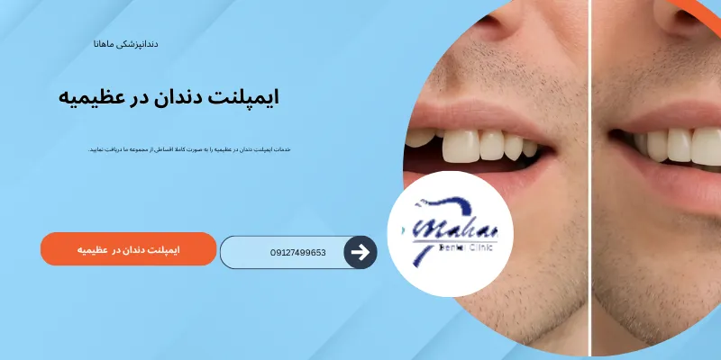 ایمپلنت دندان در عظیمیه کرج