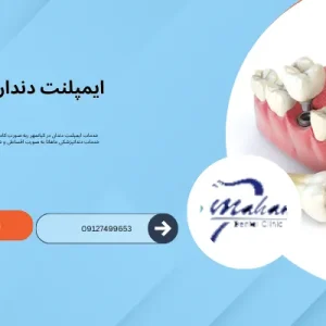 ایمپلنت دندان در کیانمهر کرج