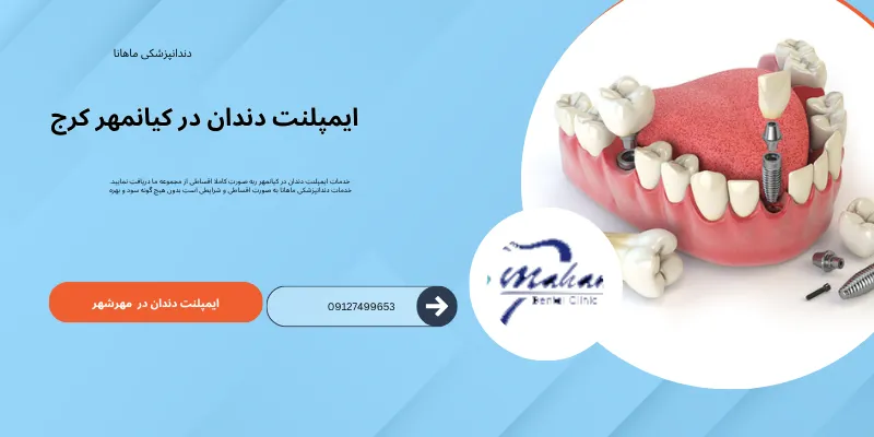 ایمپلنت دندان در کیانمهر کرج