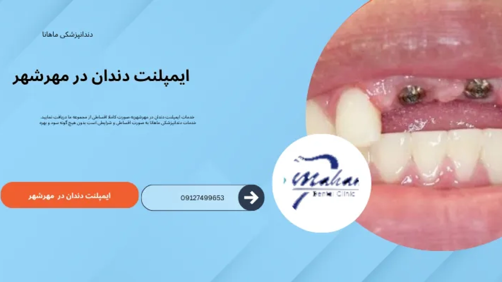 ایمپلنت دندان در مهرشهر