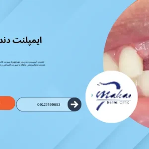 ایمپلنت دندان در مهرشهر
