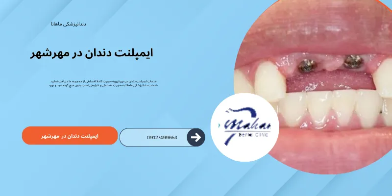 ایمپلنت دندان در مهرشهر