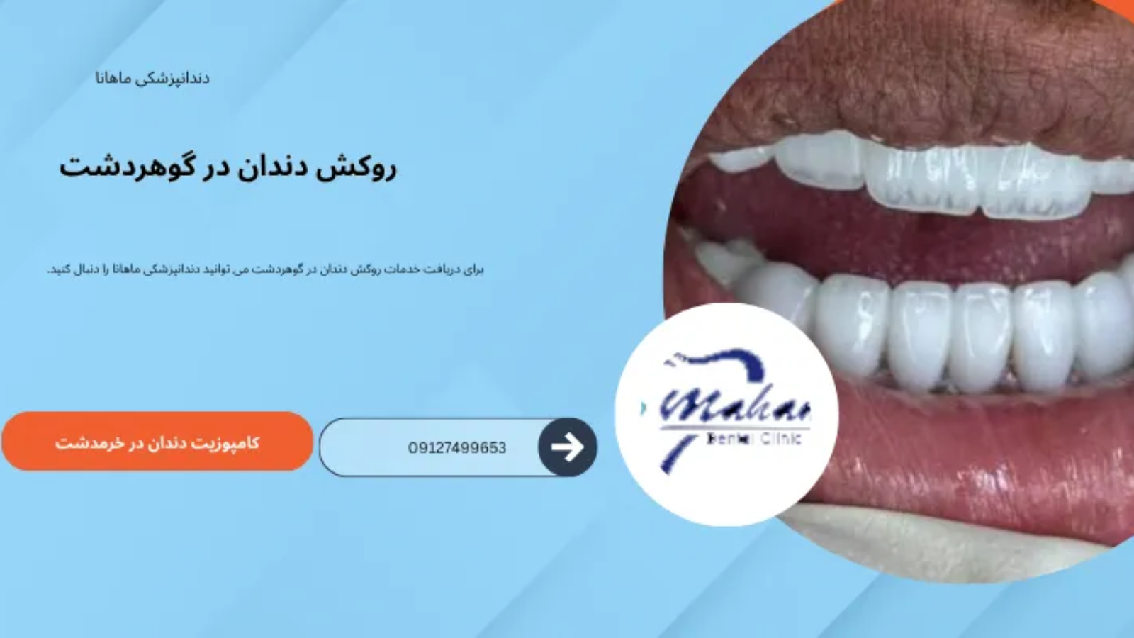 روکش دندان در گوهردشت کرج