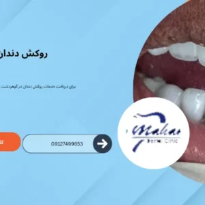 روکش دندان در گوهردشت کرج
