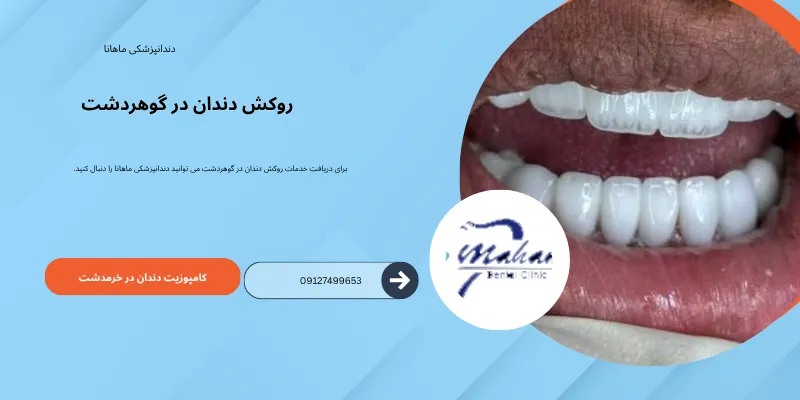 تصویر مرتبط با روکش دندان به عنوان یکی از گزینه‌های بازسازی